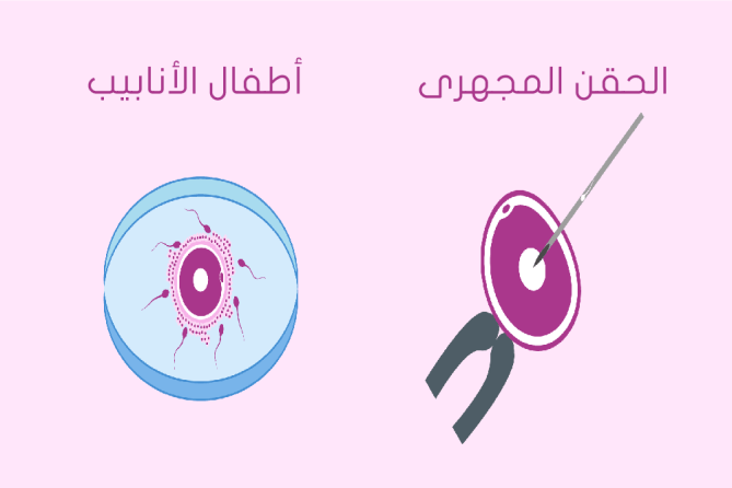 الفرق بين الحقن المجهري وأطفال الأنابيب